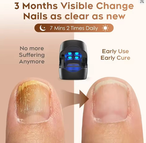 Nail fungus treatment led - nail,