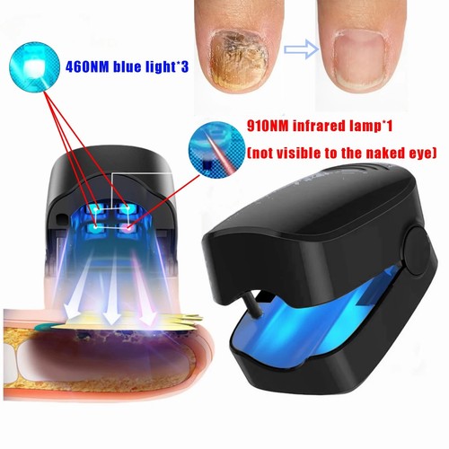 Nail fungus treatment - fungus, light