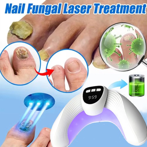 Nail fungus laser - fungus,